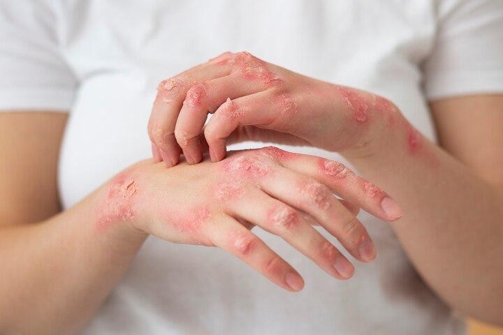 Dermatóloga Laura Sánchez asegura la lepra se cura y tiene tratamiento gratuito en República Dominicana 4 img 3887