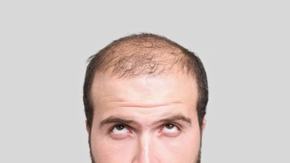 Caída del cabello: mitos, causas médicas y cuándo acudir al especialista para un tratamiento efectivo