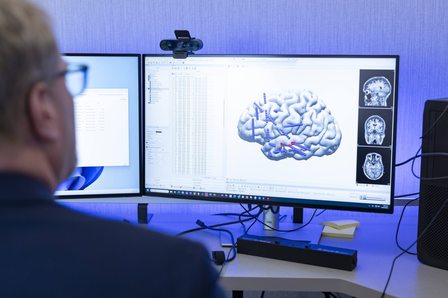 IA y dispositivos portátiles&nbsp;transforman el tratamiento de la epilepsia