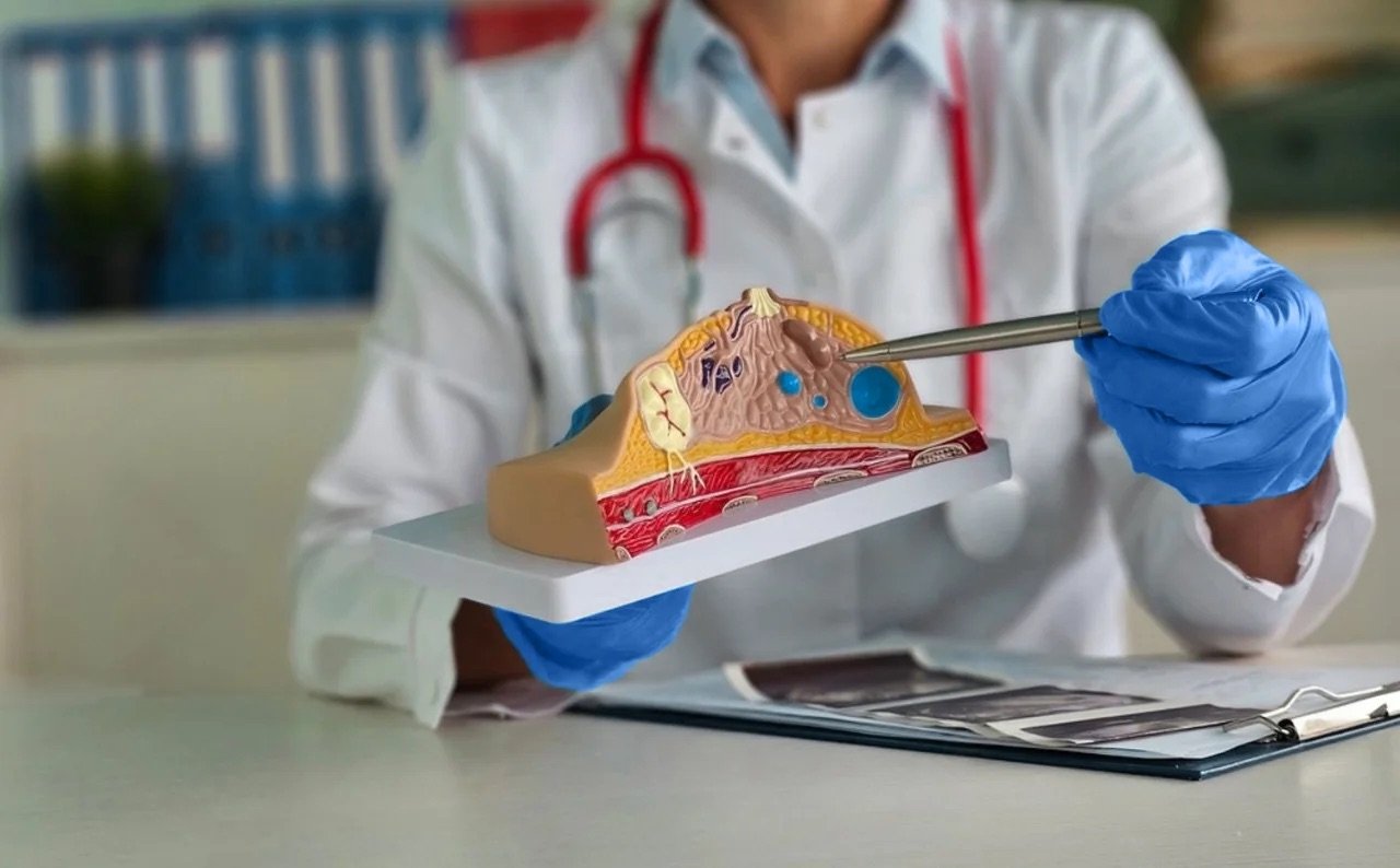 Avances en el tratamiento del cáncer de mama permiten terapias más precisas